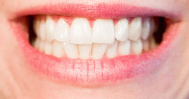 dental-bridge dental-bridge